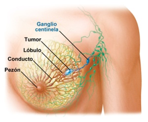 cancer-de-mama-lymph-node